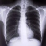 x-ray