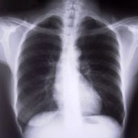 x-ray